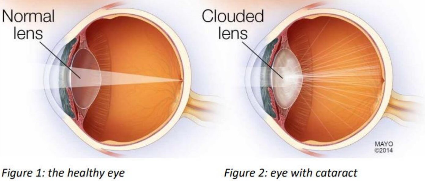 an image about cataracts