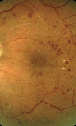 what is diabetic eye disease - Ophthalmologists in Burleson